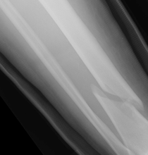 x-ray of a broken bone