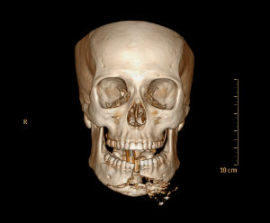 Photo of a skeleton with bones broken around the mouth/jaw area