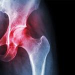 X-ray image of human hip
