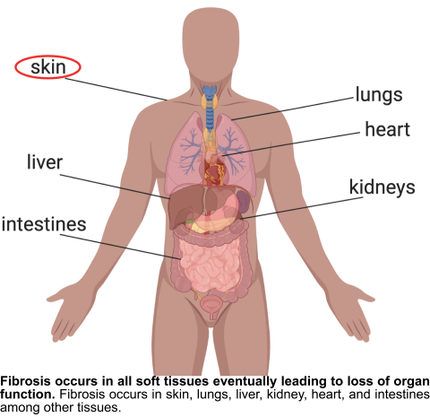 Anatomy diagram of fibrosis. Bottom text reads: Fibrosis occurs in all soft tissues leading to loss of organ function. Fibrosis occurs in skin, lungs, liver, kidney, heart, and intestines among other tissue 