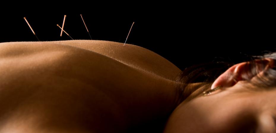 Image of woman lying down with acupuncture needs in her back