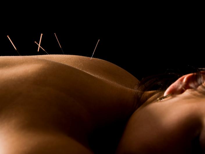 Image of woman lying down with acupuncture needs in her back