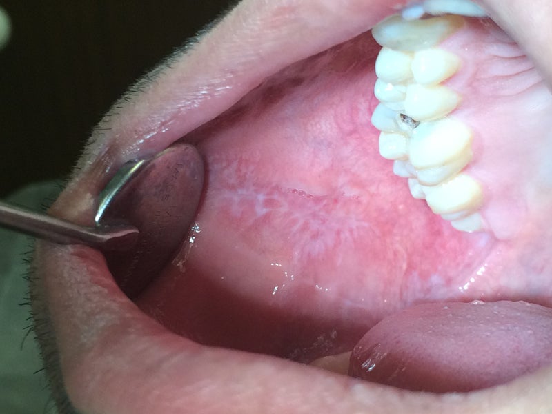 A patient's mouth with lichen planus