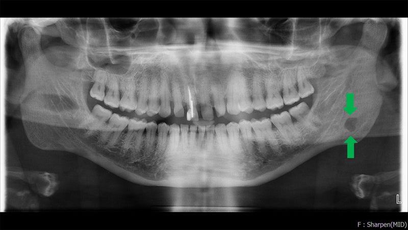 SBD x-ray 