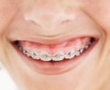 A smile with braces on the teeth.