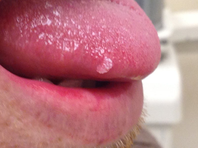 Patient's mouth with squamous papilloma