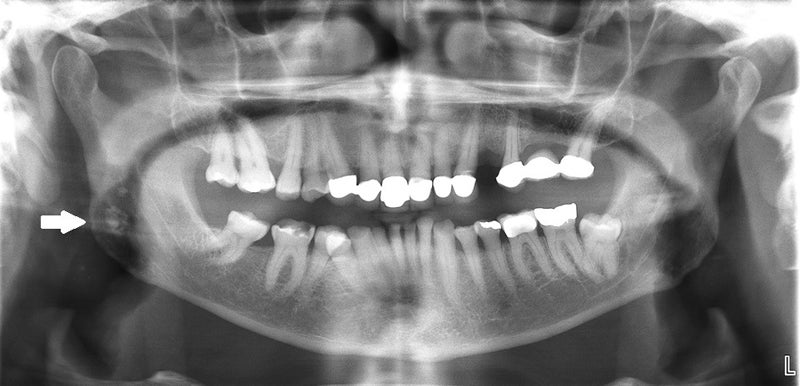 Tonsillolith x-ray