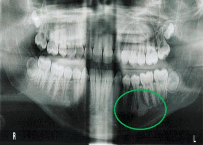 Bone island x-ray