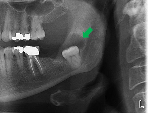 Dentigerous cyst x-ray