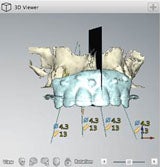 Model of top row of teeth