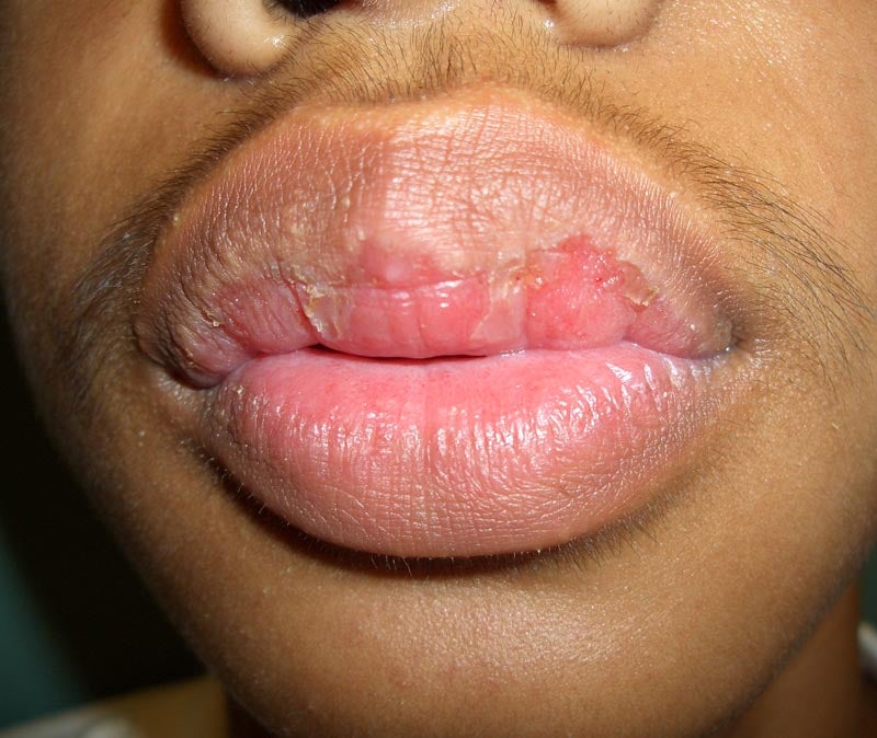 Patient's lips with orofacial granulomatosis
