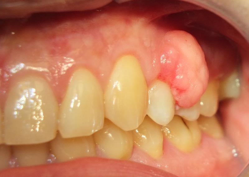 Patient's mouth with peripheral odontogenic fibroma