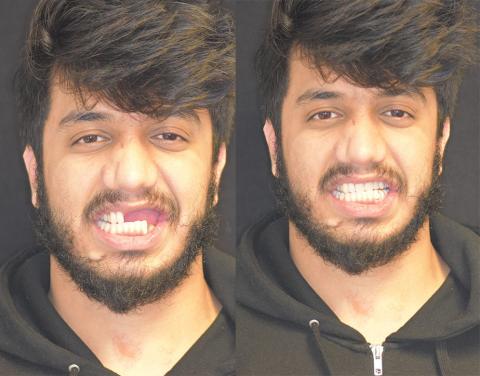 Talha Ali, before and after surgery