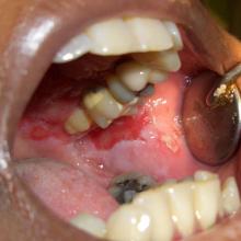 Paitent's mouth with pemphigus vulgaris