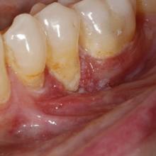 Clinical Photo of Teeth and Gums