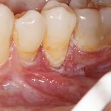 Clinical Photo of Teeth and Gums