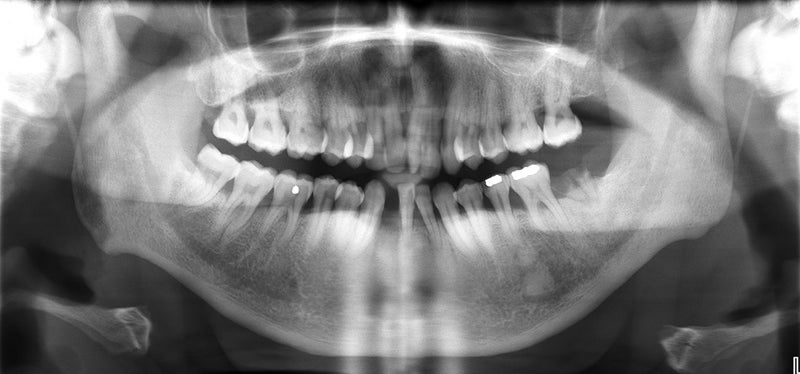 Patient's mouth x-ray with F.O.D