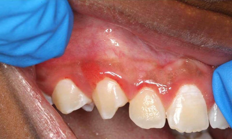 Patient's mouth with LJSGH