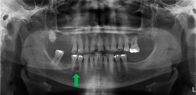 Lateral periodontal cyst x-ray