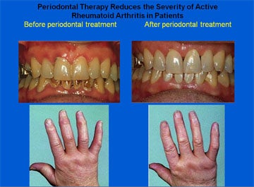Periodontal Therapy Reduces the Severity of Active Rheumatoid Arthritis in Patients Before periodontal treatment After periodontal treatment