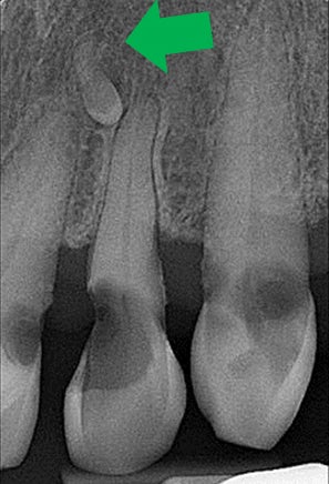 Supernumerary Tooth x-ray