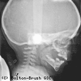 X-ray of a child's head