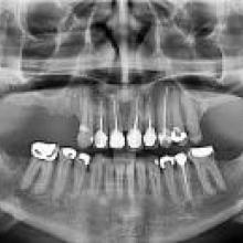 Xray of teeth that has dental work done on them.