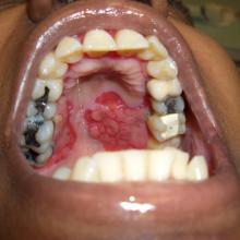 Patient's mouth with pemphigus vulgaris
