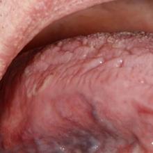 Clinical Photo of Tongue Lesions