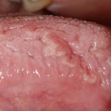 Clinical Photo of Tongue Lesions