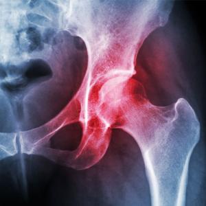 osteoarthritis joint