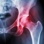 osteoarthritis joint
