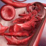 Sickle cell disease
