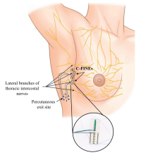An illustration of the sensory implant for bionic breast