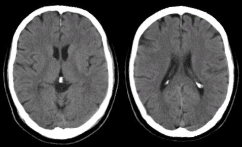 brain cat scan
