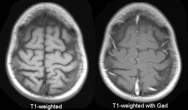 gadolinium mri