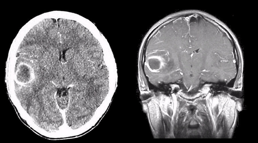 Brain Abscess