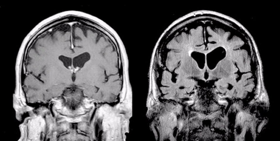 Dementia Vs Normal Brain Mri Scan