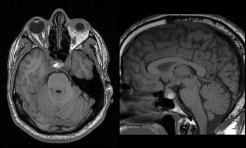 enlarged pituitary gland mri