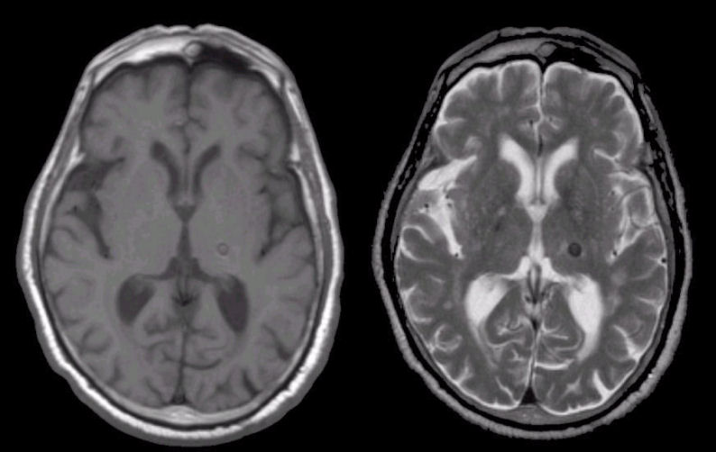 T1 weighted mri blood