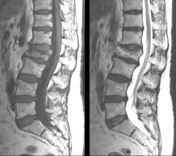 compression fracture in back