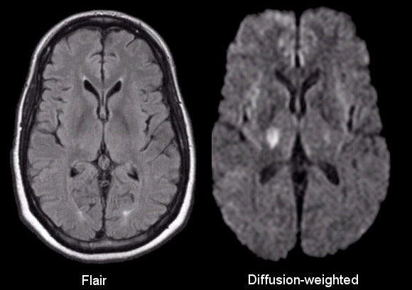 Cor T2 Mri Of Brain