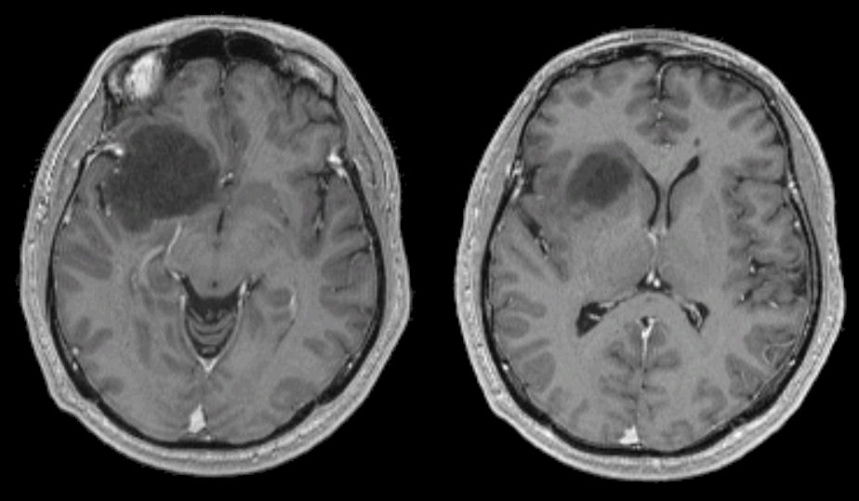 glioma-low-grade