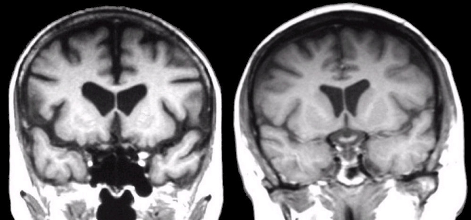 huntington's disease brain vs normal brain