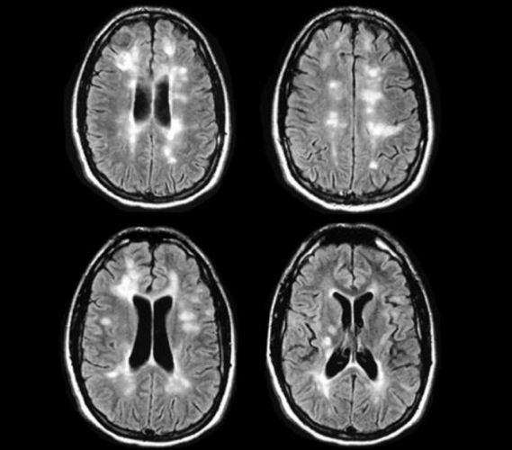 explain multiple sclerosis brain mri
