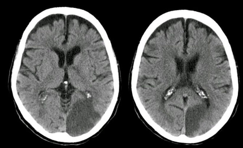 Posterior Cerebral Artery Stroke
