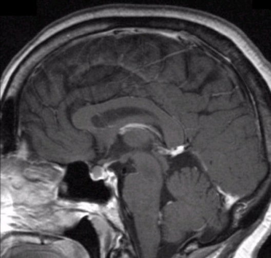 microadenoma pituitary mri)