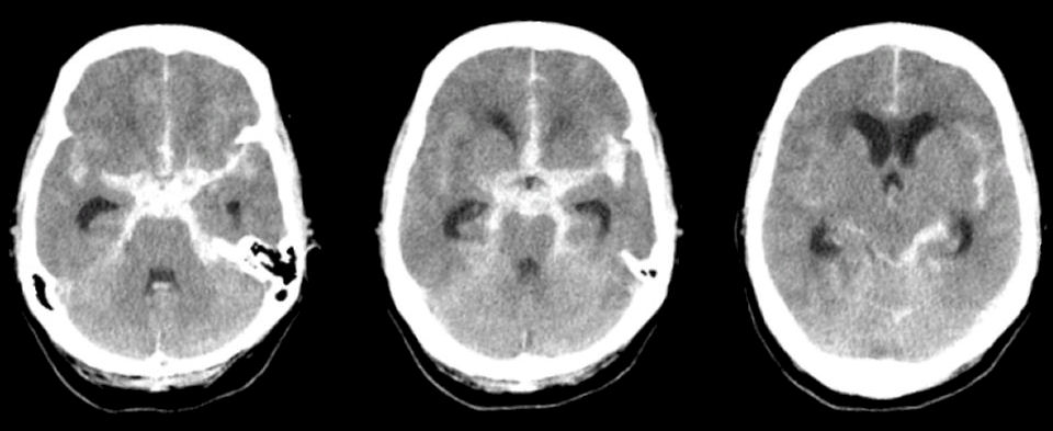 What is a Subarachnoid Hemorrhage (SAH)?