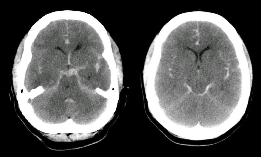 Subarachnoid Hemorrhage