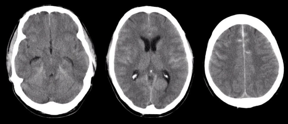 Subarachnoid Hemorrhage